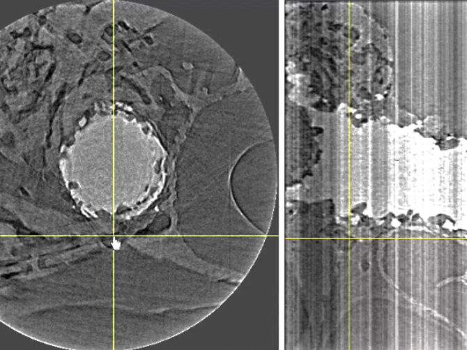 Implant